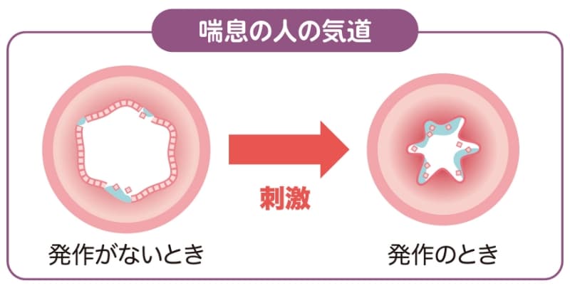 喘息の人の気道の図。刺激を受けると気道が狭まり、発作が起こる仕組みを示している。